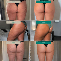 Lynae - Drainant Lymphatique - Cellulite — vue 2